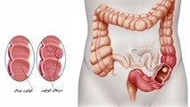 تشخیص انواع پولیپ ها و سرطان کولورکتال (روده بزرگ)